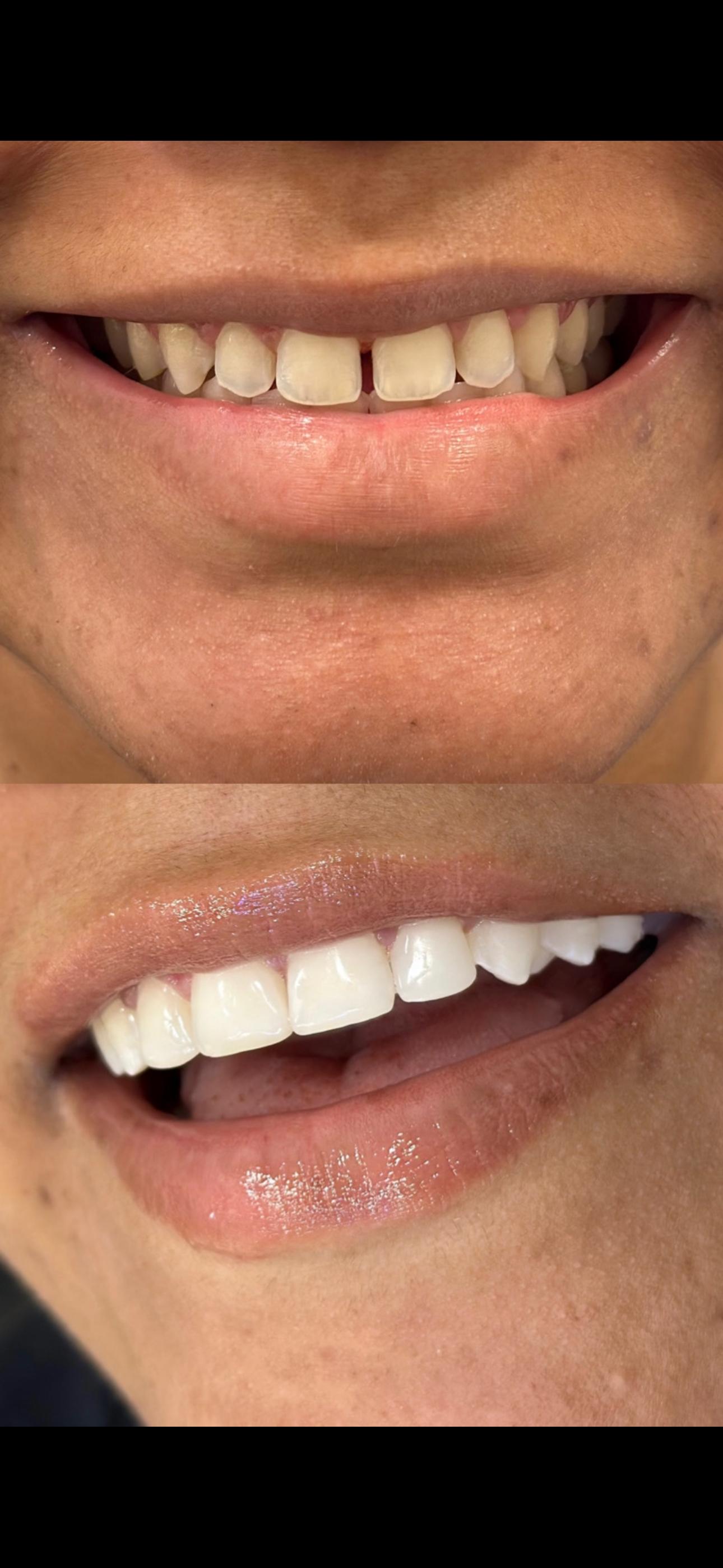Antes e depois — lentes em resina, caso clínico Dra. Monyki Nascimento