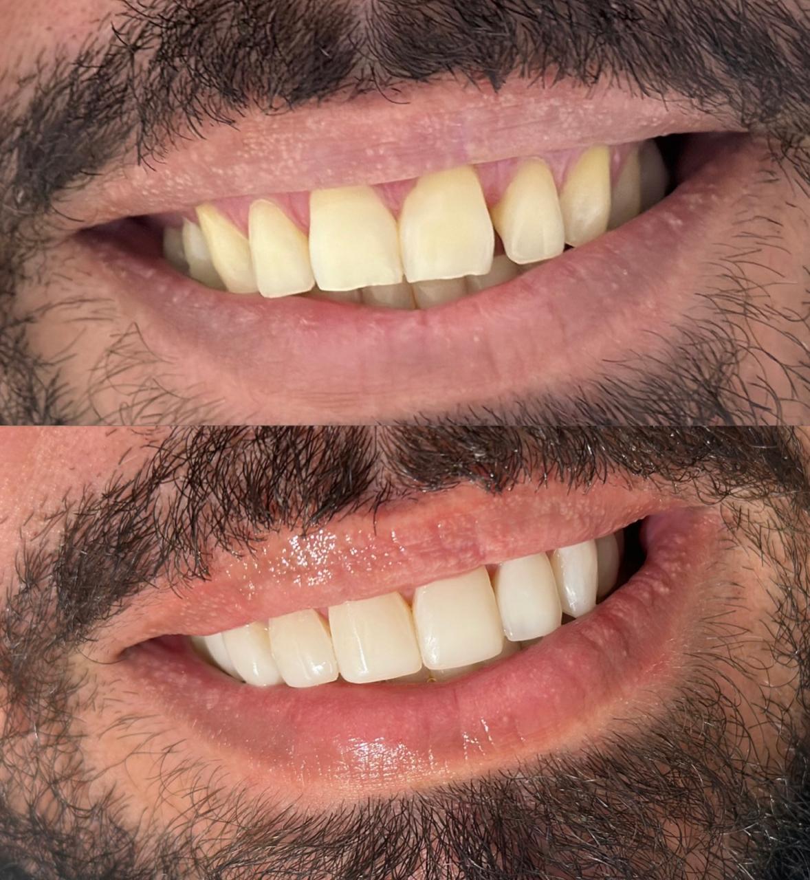Antes e depois — lentes em resina, caso clínico Dra. Monyki Nascimento