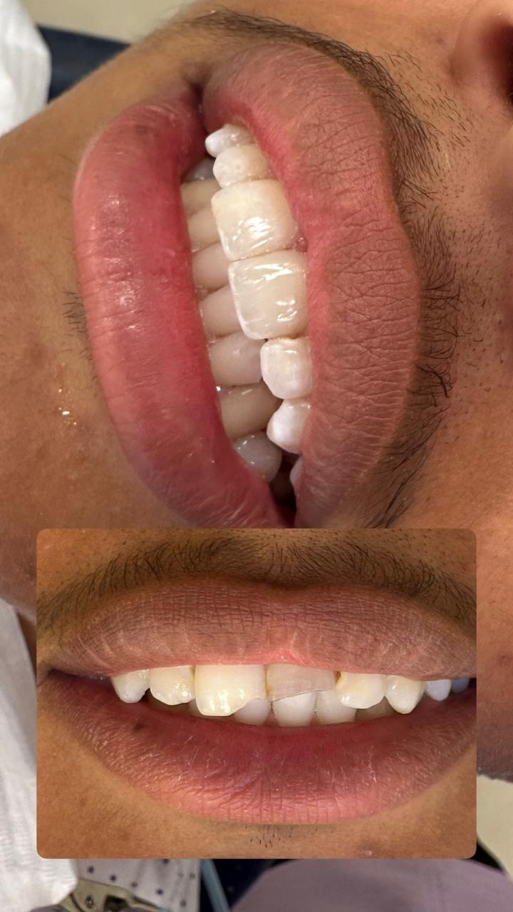 Antes e depois — lentes em resina, caso clínico Dra. Monyki Nascimento