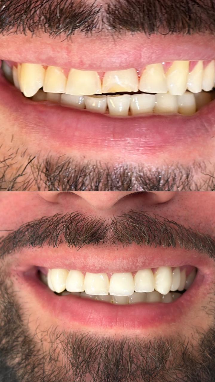 Antes e depois — lentes em resina, caso clínico Dra. Monyki Nascimento