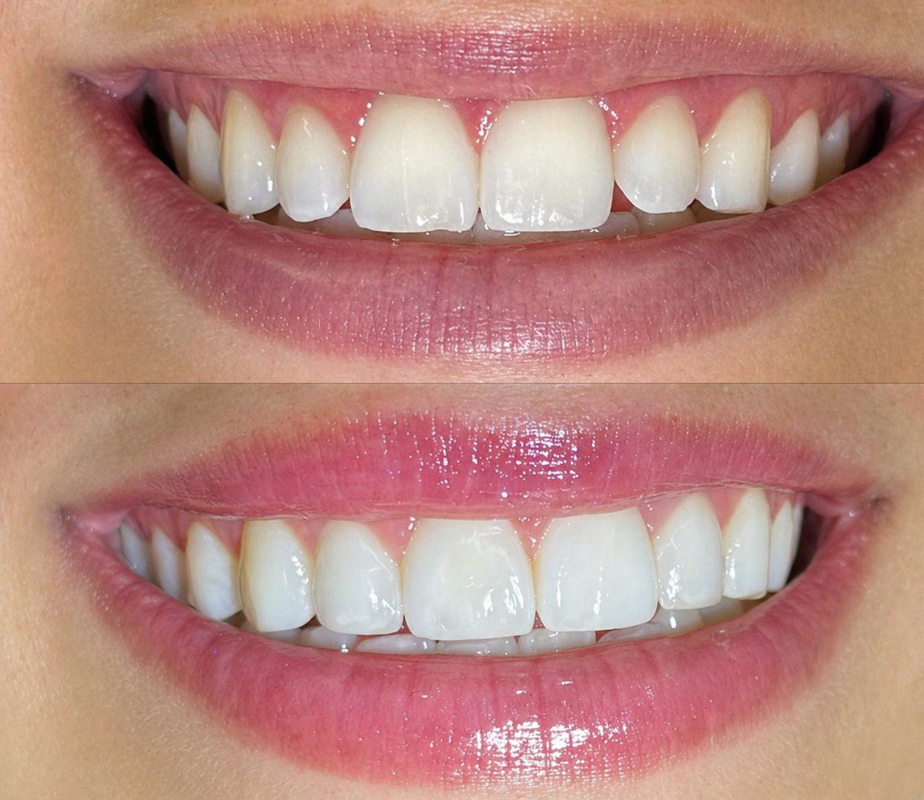 Antes e depois — recontorno incisal, caso clínico Dra. Monyki Nascimento