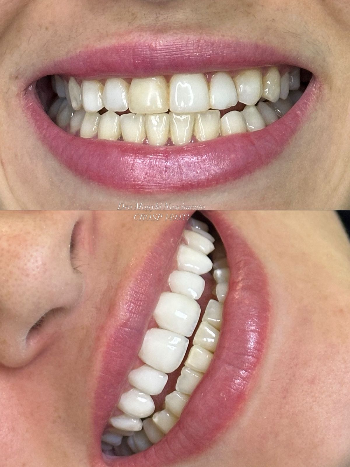 Antes e depois lentes em resina, caso clínico Dra. Monyki Nascimento