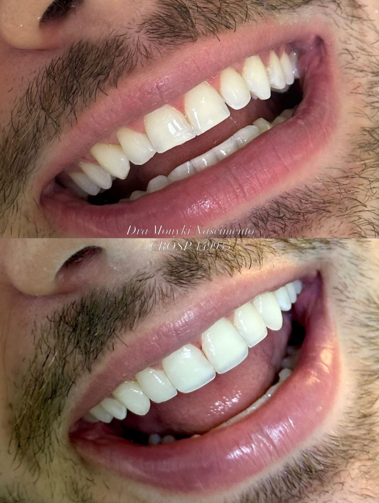 Antes e depois lentes em resina, caso clínico Dra. Monyki Nascimento